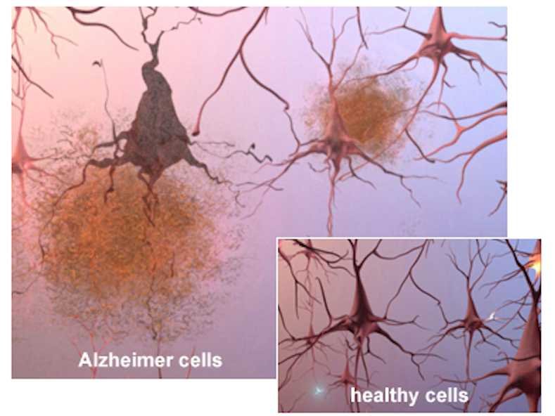 alzheimers-brain-cells-and-plaques.