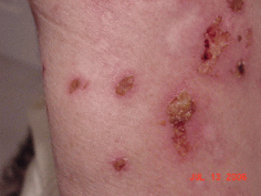 2009-04-32099-500-Images-populum_uploaded_before-right-arm-32099-20090413-6.