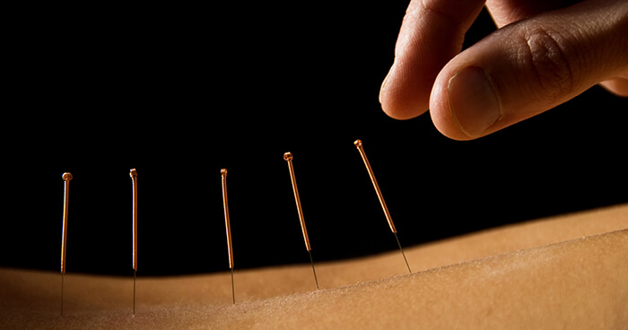 acupuncture2.
