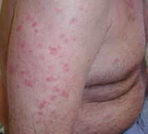 derm_clin_leukemia1010_122976.