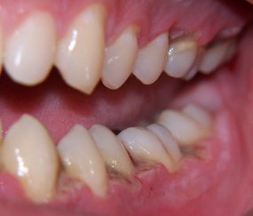 Fig-1-Necrotizing-ulcerative-gingivitis-Note-the-characteristic-gingival-papilla.