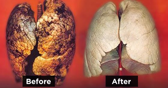 lungs-after-smoking.