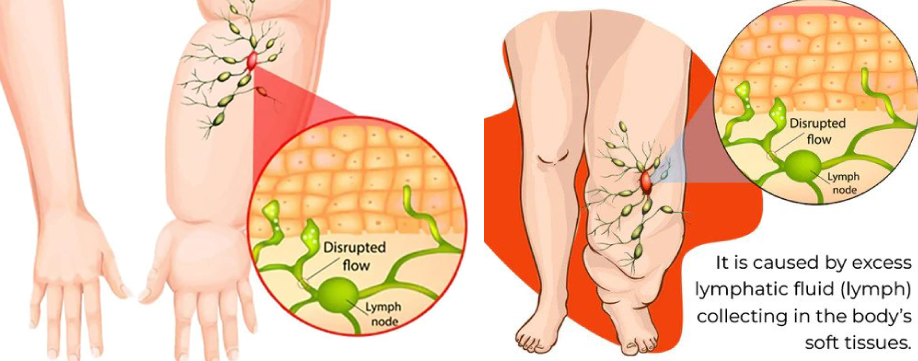 lymph-swelling_1024x1024.