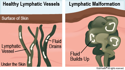 lymphaticMalform_a_enIL.