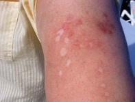 MorgellonsArmScars053106.