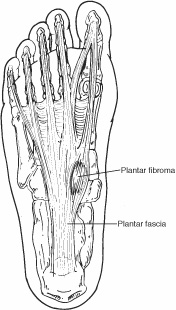 Plantar-Fibroma-Artesia-Rancho-Cucamonga-Riverside.